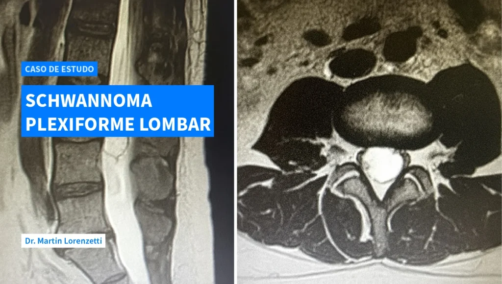 Caso de Estudo Schwannoma Plexiforme Lombar
