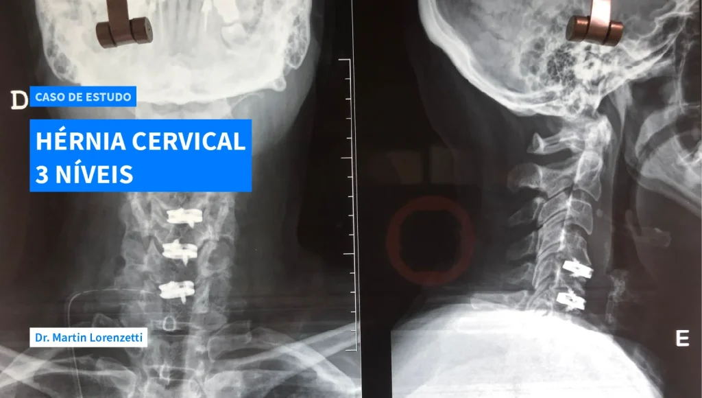 Caso de Estudo Hernia Cervical 3 Niveis