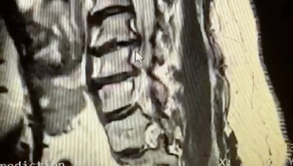 Hérnia Cercival 3 Niveis